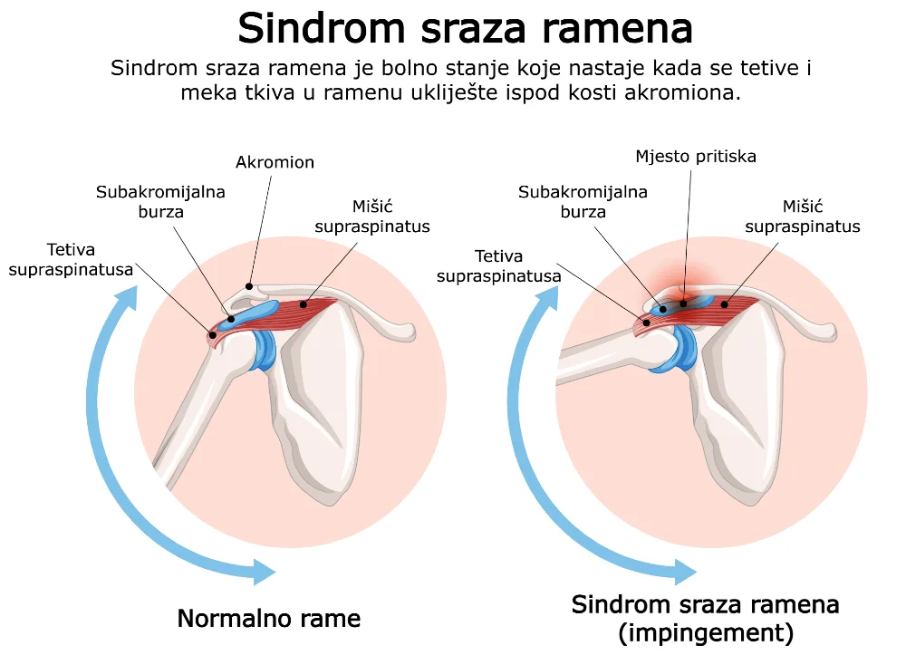 Ilustracija koja prikazuje kako nastaje impingement ramena (sindrom sraza ramena) – prikaz uklještenja tetiva u subakromijalnom prostoru.