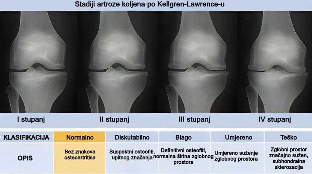 Artroza koljena - klasifikacija po Kellgren Lawrenceu u 4 stupnja