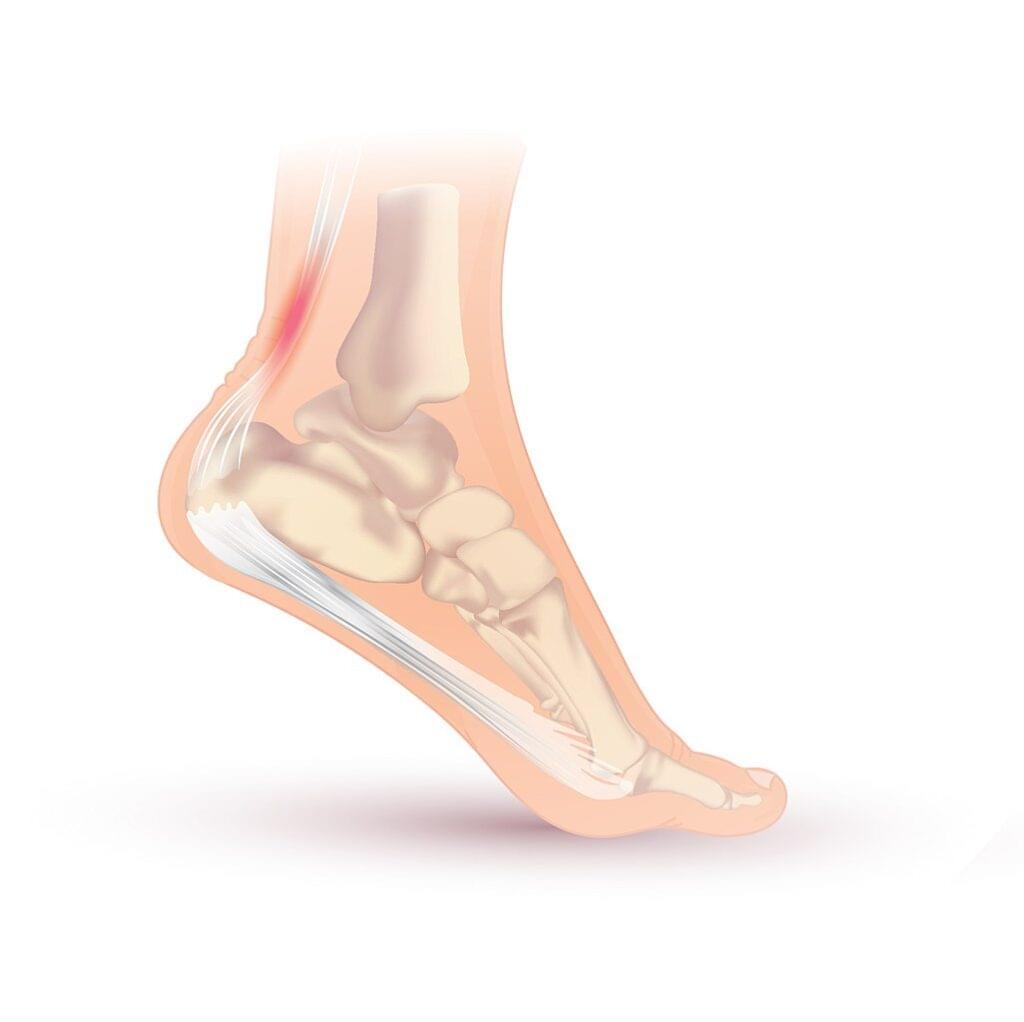 bol u peti_tendinoaptija / tendinitis Ahilove tetive / upala Ahilove tetive
