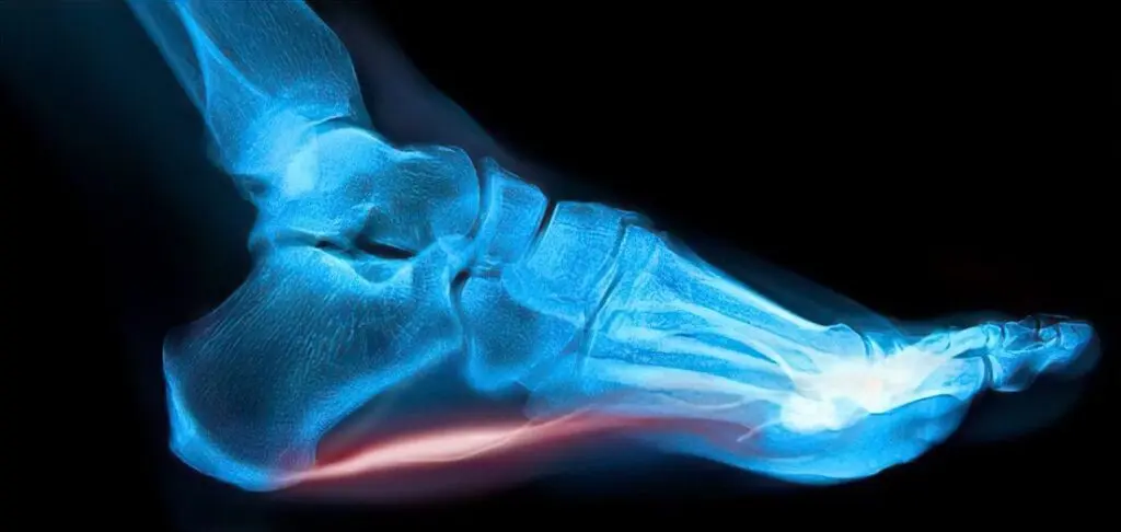 Bol u peti_plantarni fascitis
