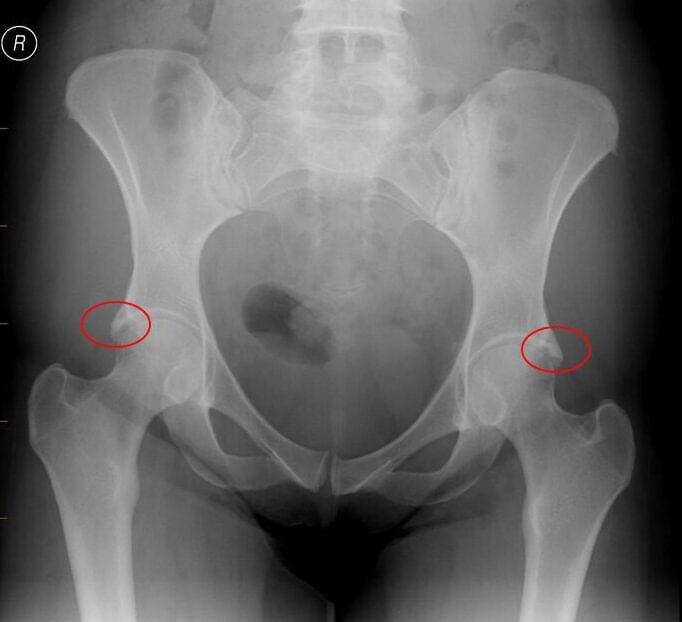 Bol u kuku - Impingement kuka (FAI) rendgenski prikaz Pincer deformiteta na rubu acetabuluma