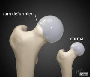 Bol u kuku - Impingement kuka (FAI) - prikaz Cam deformiteta na vratu bedrene kosti