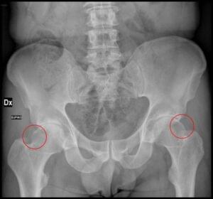 Impingement kuka (FAI) rendgenski prikaz Cam deformiteta na vratu bedrene kosti