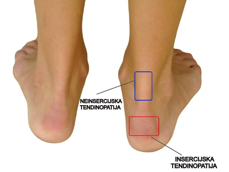 Ahilova tetiva - prikaz insercijske i neinsercijske tendinopatije Ahilove tetive
