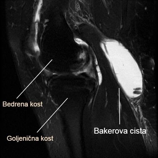 Bakerova cista - MR (magnetska rezonanca). Cista je ispunjena tekućinom što se na slici pokazuje kao bijelo područje