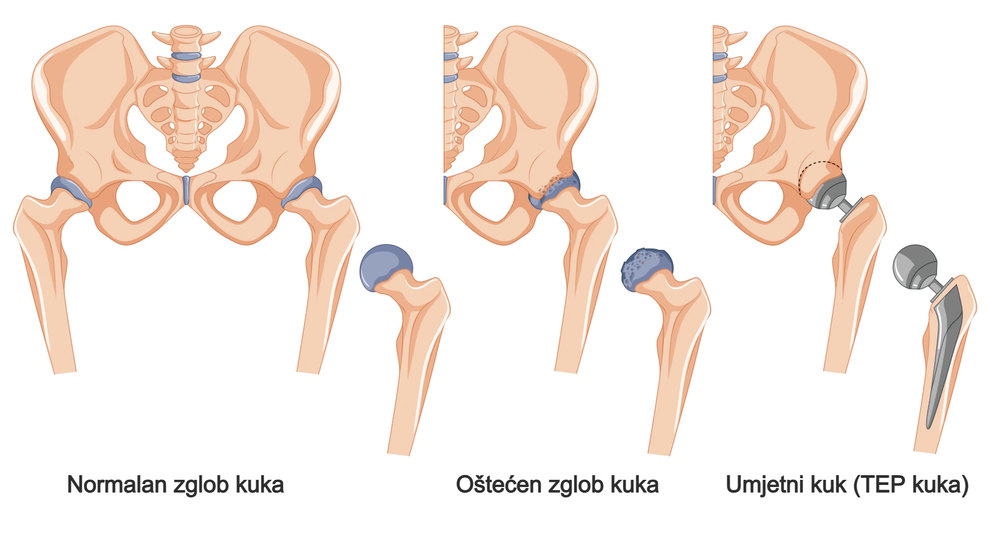 operacija kuka, TEP kuka - shematski prikaz od zdravog kuka preko štećenja kuka do umjetnog kuka