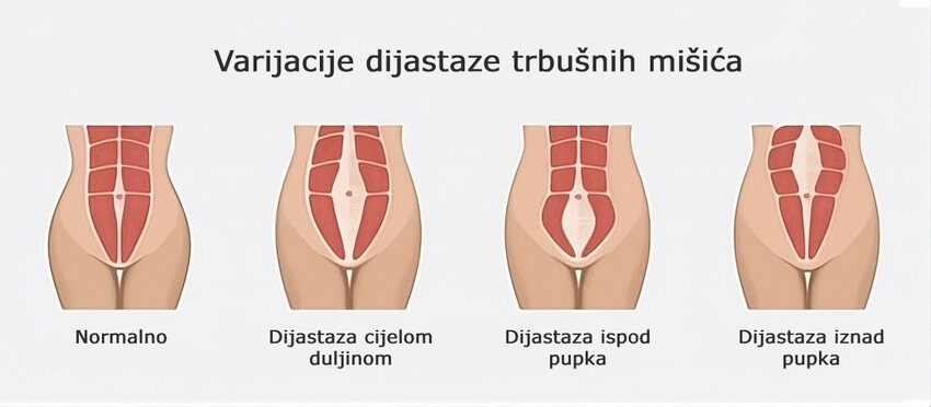 dijastaza trbuha_ skica_varijacije dijastaze trbušnih mišića