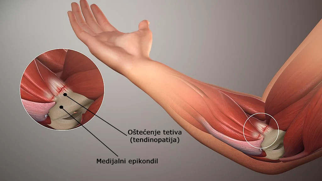Golferski lakat ili medijalni epikondilitis - shematski prikaz