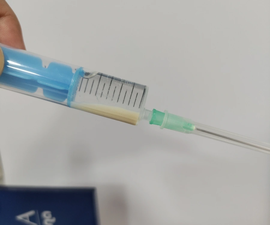 Kalcifikat u ramenu, lavaža - ispiranje kalcifikata - talog kristala kalcija u šprici.