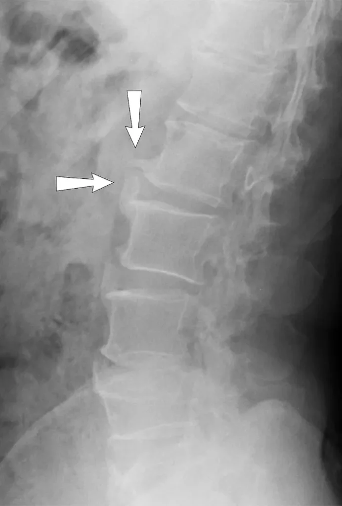 Osteofiti na rendgenu lumbalne kralježnice