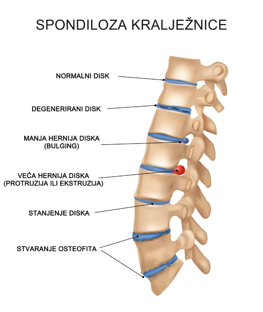 Spondiloza kralježnice - shematski prikaz