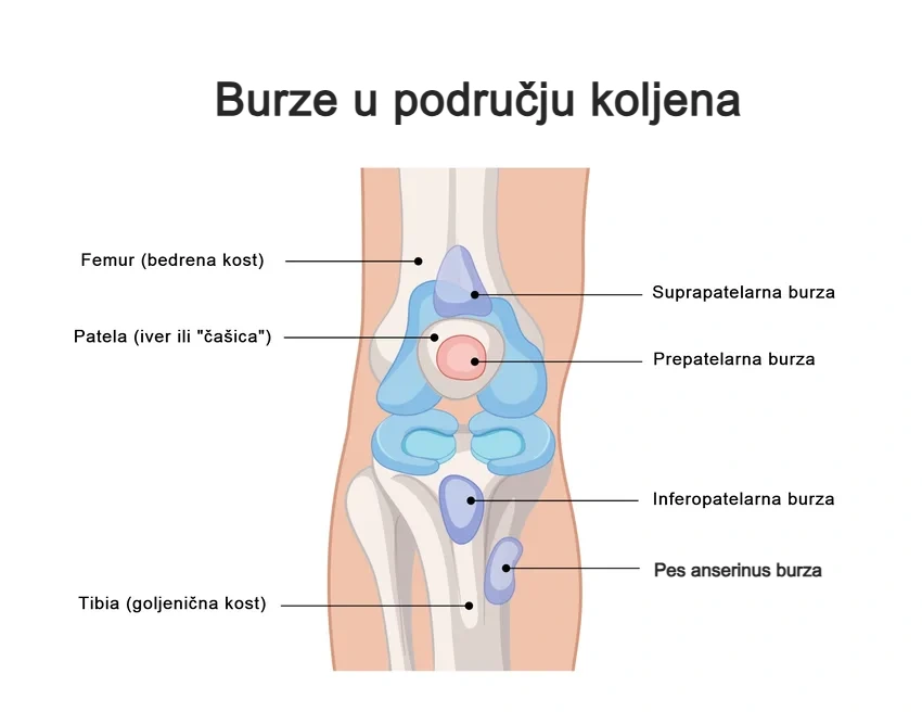 Shematski prikaz burzi u području koljena – prepatelarna, pes anserinus i infrapatelarna burza, uzrok oteklina i bolova u koljenu