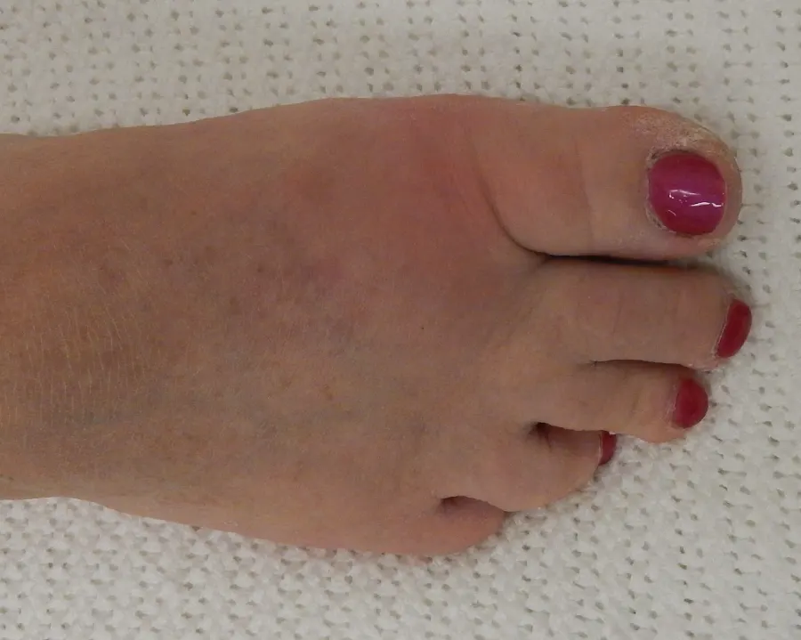 Giht: crvenilo i oteklina korijenskog zgloba palca na nozi