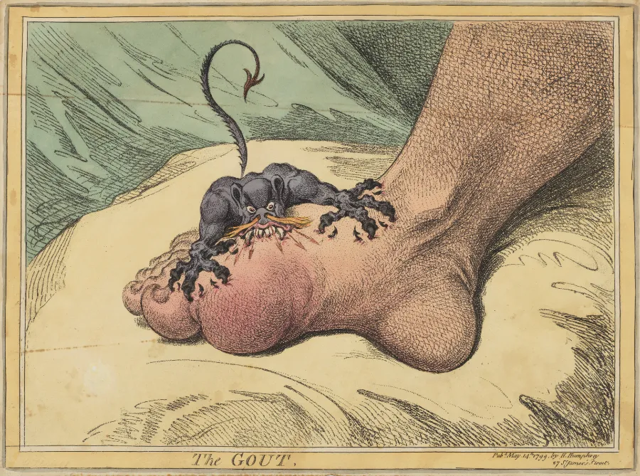 The Gout (Giht) – karikatura Jamesa Gillraya iz 1799. prikazuje demona koji grize i riga vatru na zglob palca nožnog prsta, simbolizirajući jaku bol gihta.