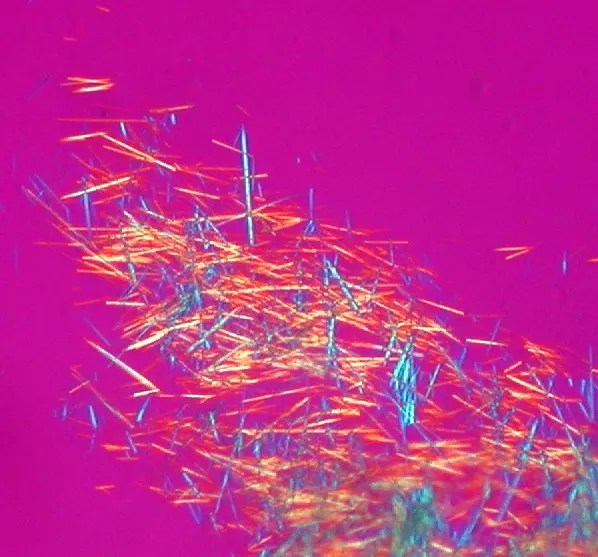 Kristali mokraćne kiseline (urata) štapićastog oblika pod polarizirajućim mikroskopom kod pacijenta s gihtom