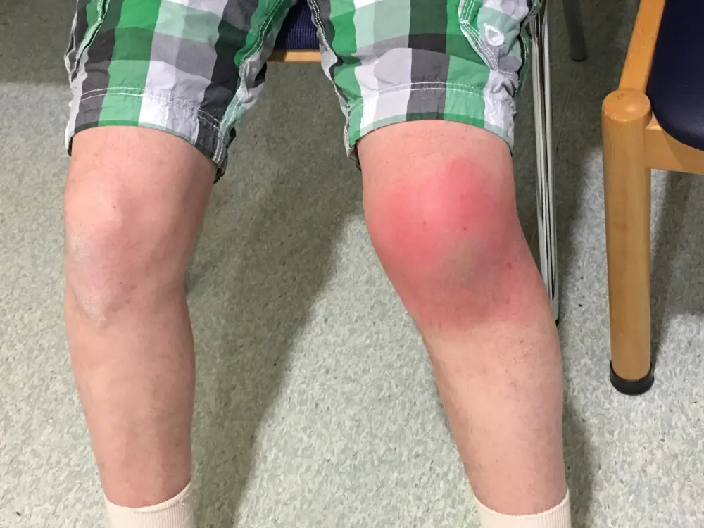 Prepatelarni burzitis koljena lijeve noge s oteklinom i crvenilom – upala burze uzrok bolova i ograničene pokretljivosti