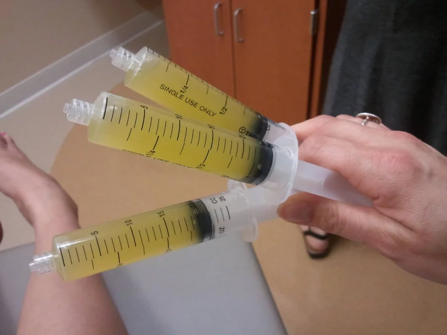 Punktat zgloba koljena – sinovijalna tekućina dobivena punkcijom. Zamućena tekućina upućuje na upalni proces u koljenu.