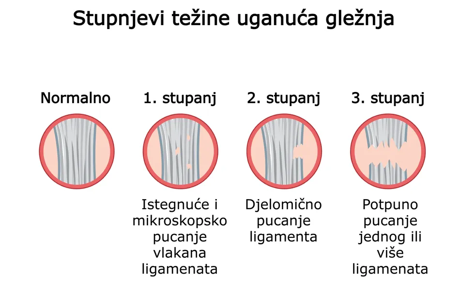 Uganuće gležnja - stupnjevi težine uganuća. Koliko je teška ozljeda gležnja.