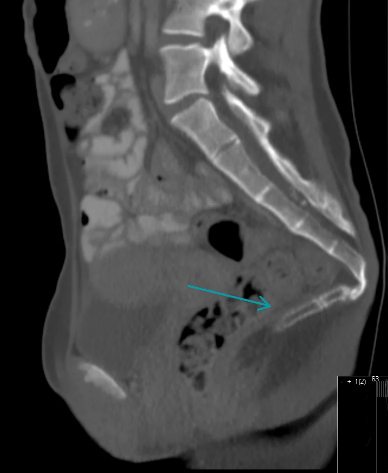 Magnetska rezonanca trtice pokazuje pretjerani otklon trtice prema naprijed (hiperfleksija coccyxa)