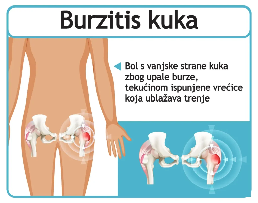 burzitis kuka - bol s vanjske strane kuka zbog upale burze