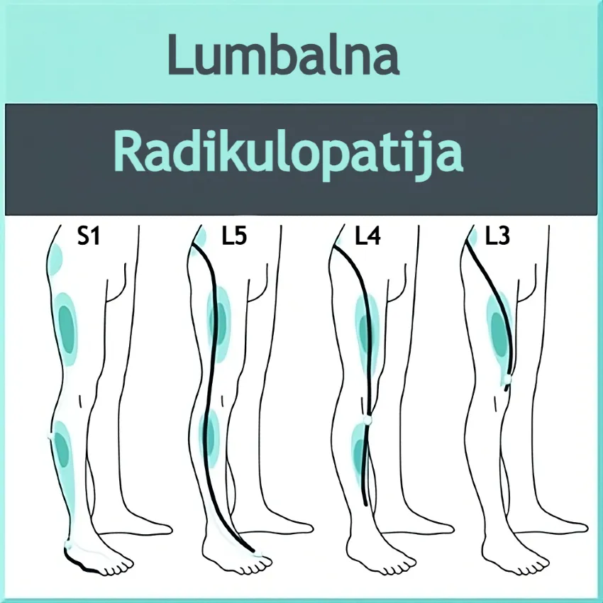 Lumbalna radikulopatija – shematski prikaz širenja boli niz nogu kod kompresije pojedinih živaca lumbalne kralježnice."