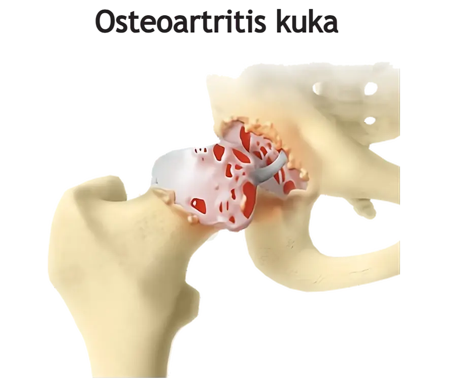 Osteoartritis (artroza) kuka ili koksartroza - shematski prikaz oštećenja zgloba degenerativnim artritisom