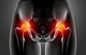 Upala kuka: Simptomi, najčešći uzroci i kada potražiti pomoć