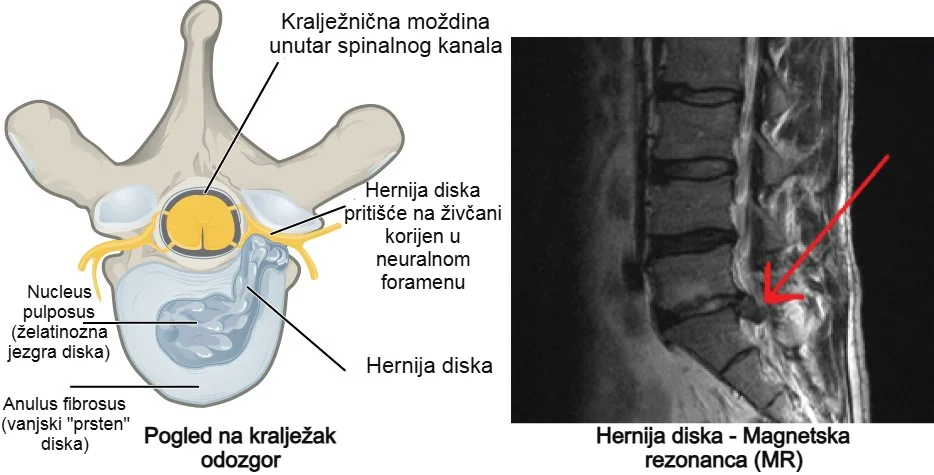 Hernija diska s kompresijom živčanog korijena u neuralnom foramenu – glavni uzrok išijasa; lijevo shematski prikaz, desno MR snimka.