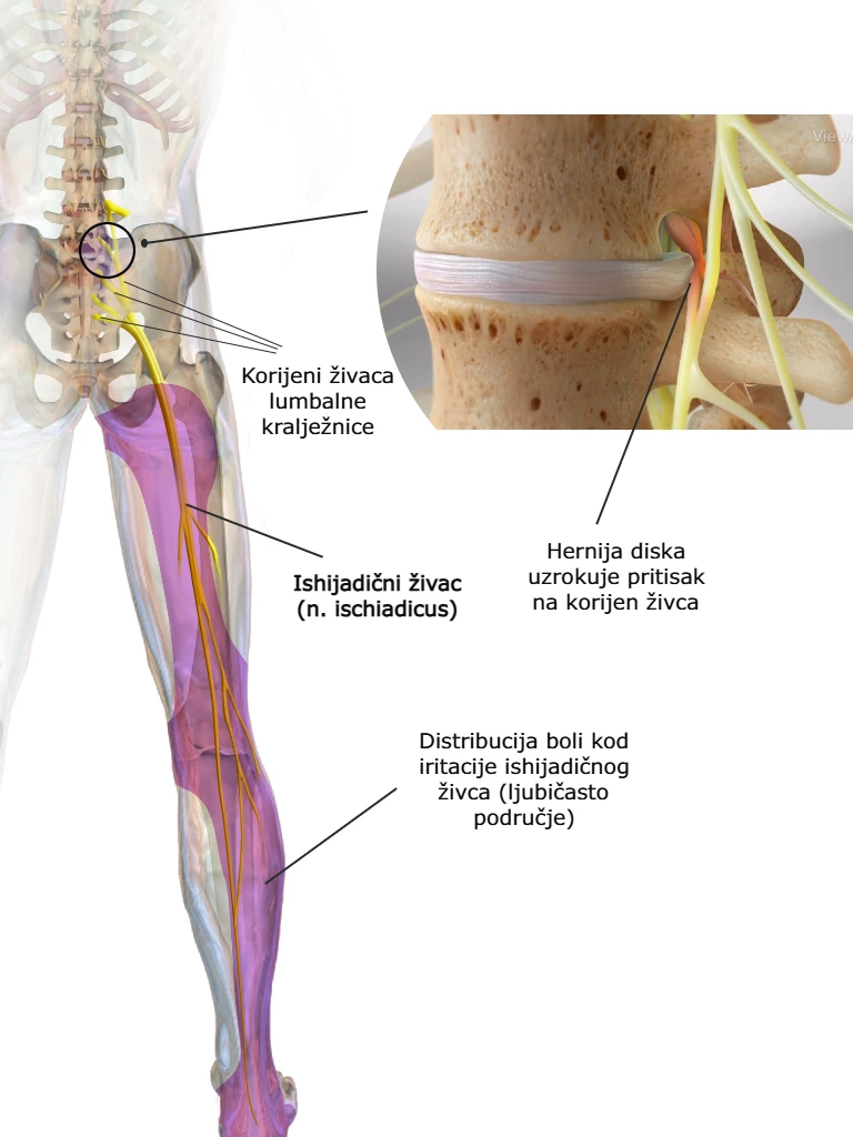 Prikaz išijadičnog živca, hernije diska i kompresije na lumbalne živčane korijene koja uzrokuje išijas.