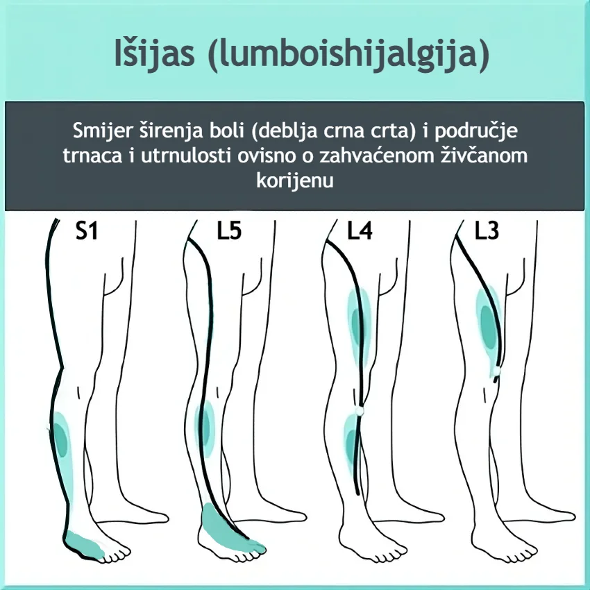 Direction of pain (thick black line) and areas of tingling or numbness (green) according to the affected nerve root in sciatica.