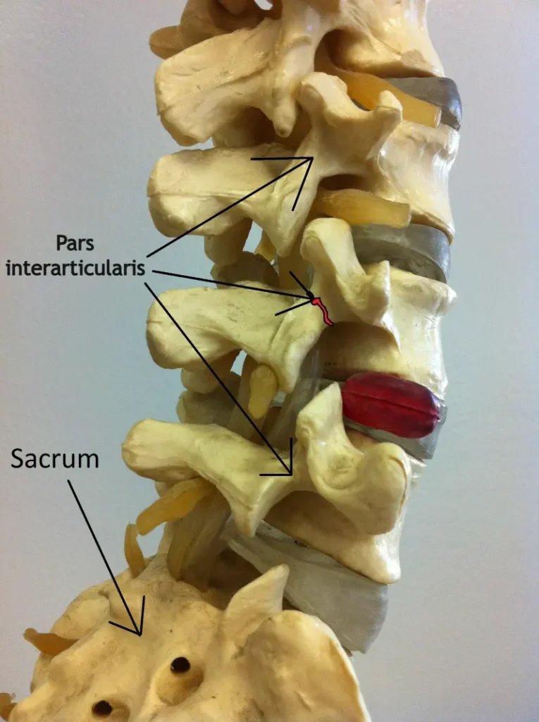 spondiloliza – anatomski model kralježnice koji prikazuje frakturu pars interarticularis kralješka