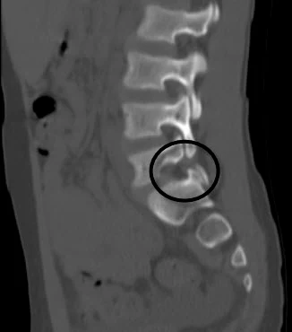 CT snimka kralježnice koja prikazuje spondilolizu – koštani defekt pars interarticularis kralješka