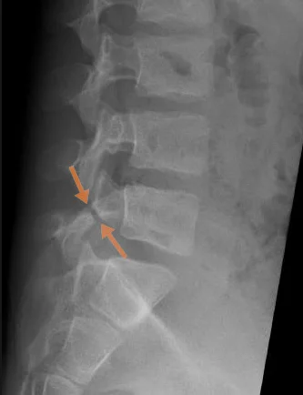 RTG snimka lumbalne kralježnice koja prikazuje spondilolizu – koštani defekt pars interarticularis kralješka