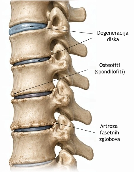 Degenerativne promjene kralježnice (spondiloza) s vidljivom degeneracijom diska, osteofitima i artrozom fasetnih zglobova